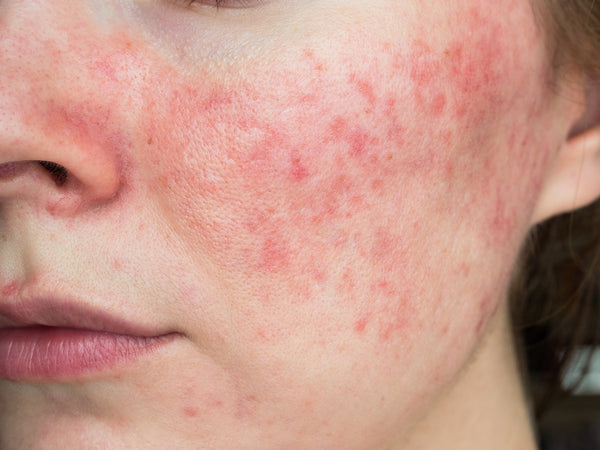 Irritated & red skin