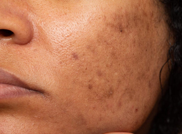 Dark Spots & Hyperpigmenation